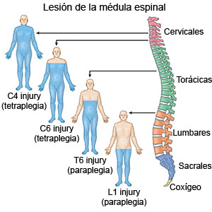 Lesión de la médula espinal