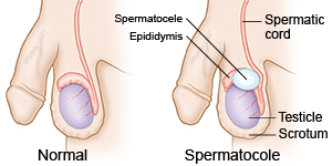 NORMAL/SPERMATOCELE