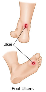 Foot Ulcers