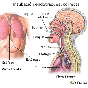 Intubación endotraqueal adecuada