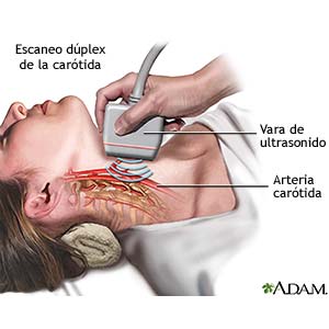 Dúplex carotídeo