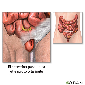 El intestino que pasa por el escroto o la ingle