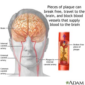 Pieces of plaque can break free, travel to the brain, and block blood vessels that supply blood to the brain