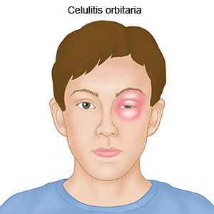 Celulitis orbitaria