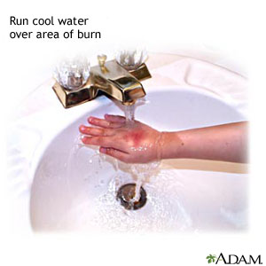 Run cool water over area of burn