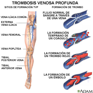 Trombosis venosa profunda