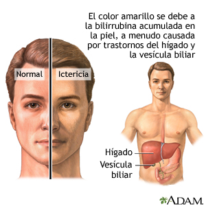 Ictericia normal