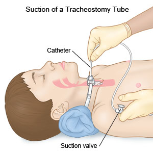 Suction of a Tracheostomy Tube