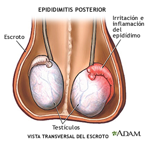Epididimitis posterior