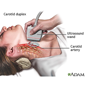 Carotid Duplex