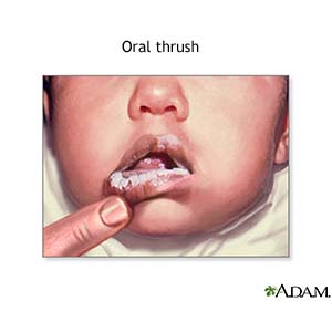 Oral Thrush