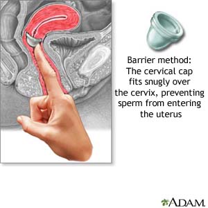 Barrier Method: The cervical cap fits snugly over the cervix, preventing sperm from entering the uterus