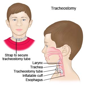 Tracheostomy 