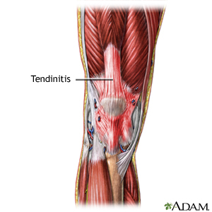 Tendinitis