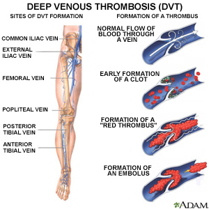 Deep Venous Thrombosis (DVT)