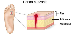 Herida punzante